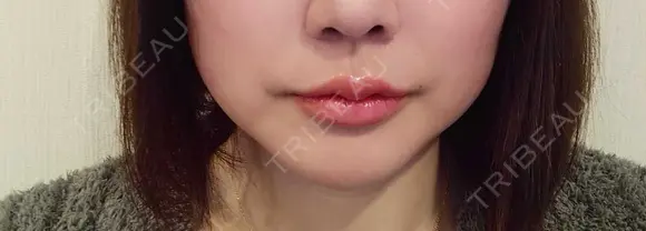 ヒアルロン酸注入（涙袋） / ヒアルロン酸注入（唇） 共立美容外科 梅田院 DAY 2 メイン用