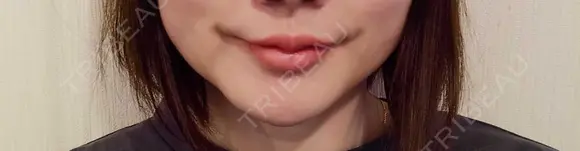 ヒアルロン酸注入（涙袋） / ヒアルロン酸注入（唇） 共立美容外科 梅田院 DAY 3 メイン用