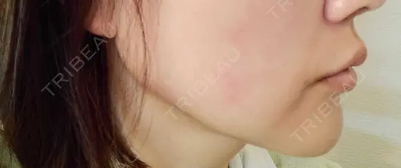 ヒアルロン酸注入（涙袋） / ヒアルロン酸注入（唇） 共立美容外科 梅田院 DAY 3 メイン用