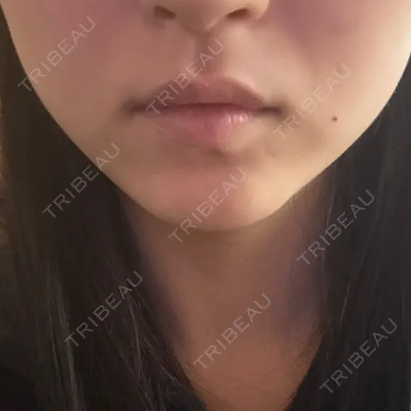 ハイフ（顔） 表参道メディカルクリニック 名古屋院 AFTER メイン用