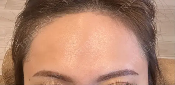 アートメイク（眉） / アートメイク（唇） / アートメイク（ヘアライン） LEAGRANT CLINIC 中目黒 DAY 10 メイン用