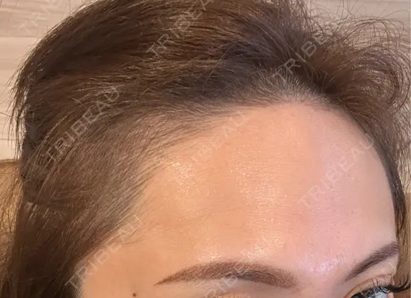アートメイク（眉） / アートメイク（唇） / アートメイク（ヘアライン） LEAGRANT CLINIC 中目黒 DAY 10 メイン用