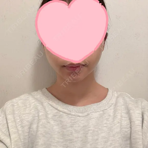糸リフト / 脂肪吸引（顔） EMMA CLINIC（エマクリニック） DAY 32 メイン用