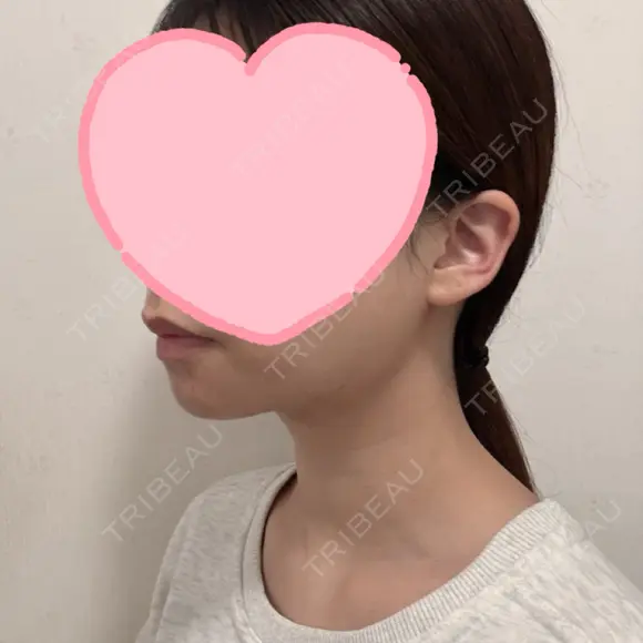 糸リフト / 脂肪吸引（顔） EMMA CLINIC（エマクリニック） DAY 32 メイン用