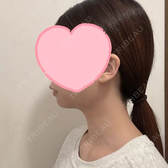 糸リフト / 脂肪吸引（顔） EMMA CLINIC（エマクリニック） DAY 32 メイン用