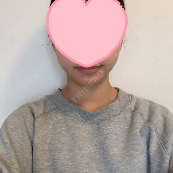 糸リフト / 脂肪吸引（顔） EMMA CLINIC（エマクリニック） AFTER メイン用