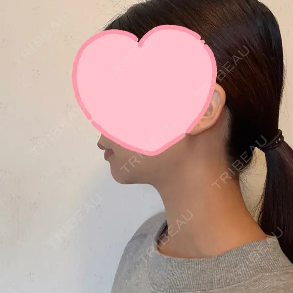 糸リフト / 脂肪吸引（顔） EMMA CLINIC（エマクリニック） DAY 90 メイン用