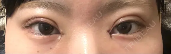 二重埋没 / 目頭切開 HAAB×DREAM BEAUTY CLINIC 大阪梅田院 DAY 3 メイン用
