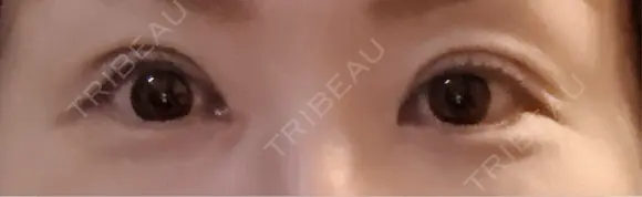 二重埋没 / 目頭切開 / 下まぶたの脂肪取り / タレ目形成・グラマラスライン（切開） 池袋麗歯科・美容皮膚科 DAY 10 メイン用