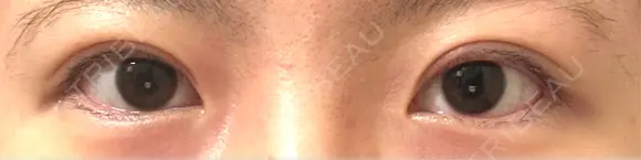 二重切開 EMMA CLINIC（エマクリニック） AFTER メイン用