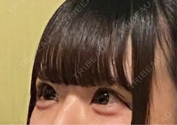 ヒアルロン酸注入（涙袋） Olino美容外科・美容皮膚科 AFTER メイン用