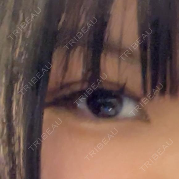 二重埋没 TCB東京中央美容外科 高崎院 AFTER メイン用