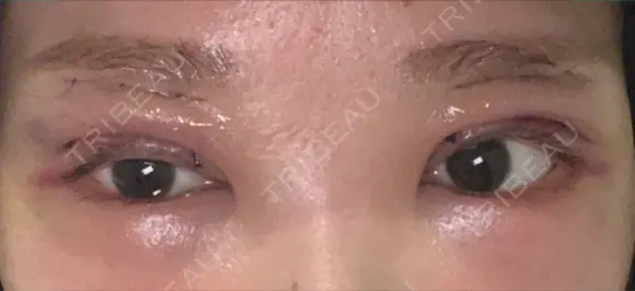 二重切開 郡山タウン形成外科クリニック DAY 1 メイン用