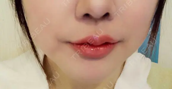 ヒアルロン酸注入（涙袋） / ヒアルロン酸注入（唇） 共立美容外科 梅田院 DAY 4 メイン用