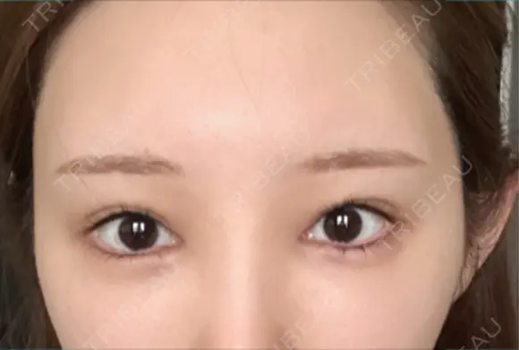 眼瞼下垂（非切開） SOL CLINIC AFTER メイン用