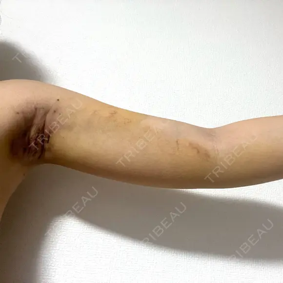 ワキ汗治療（切開） オーキッド美容クリニック東京御徒町 DAY 7 メイン用