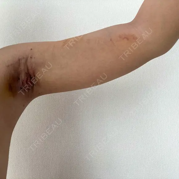 ワキ汗治療（切開） オーキッド美容クリニック東京御徒町 DAY 8 メイン用