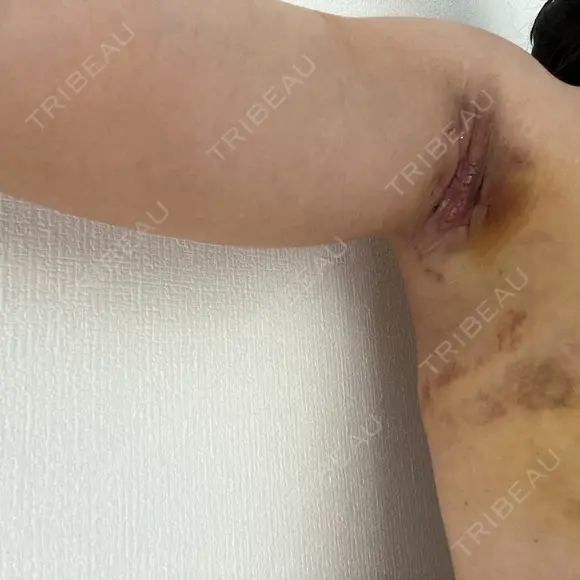 ワキ汗治療（切開） オーキッド美容クリニック東京御徒町 DAY 8 メイン用