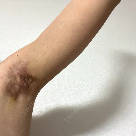 ワキ汗治療（切開） オーキッド美容クリニック東京御徒町 DAY 14 メイン用