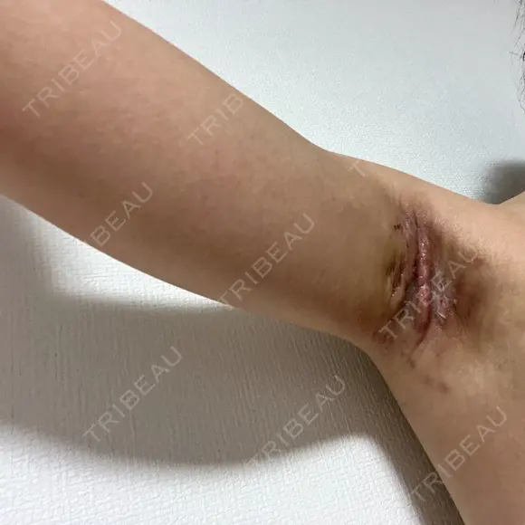 ワキ汗治療（切開） オーキッド美容クリニック東京御徒町 DAY 14 メイン用