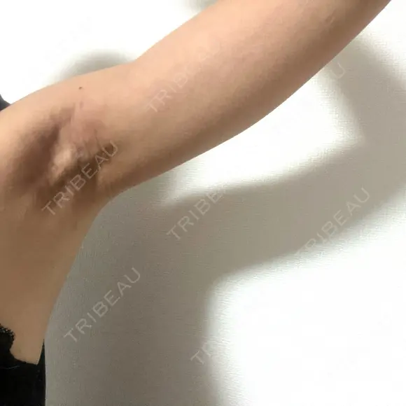 ワキ汗治療（切開） オーキッド美容クリニック東京御徒町 DAY 31 メイン用