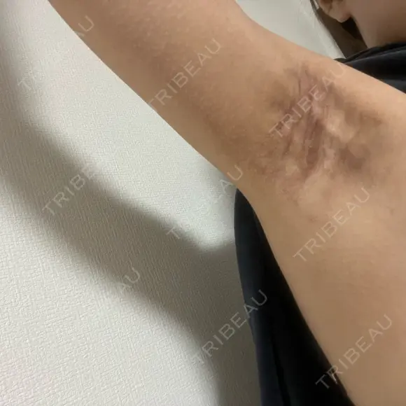 ワキ汗治療（切開） オーキッド美容クリニック東京御徒町 DAY 31 メイン用