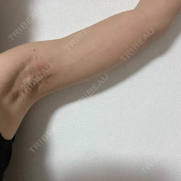 ワキ汗治療（切開） オーキッド美容クリニック東京御徒町 AFTER メイン用