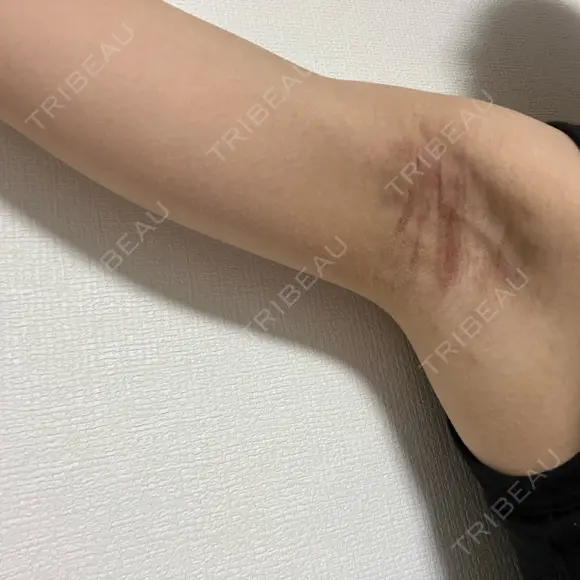 ワキ汗治療（切開） オーキッド美容クリニック東京御徒町 DAY 46 メイン用