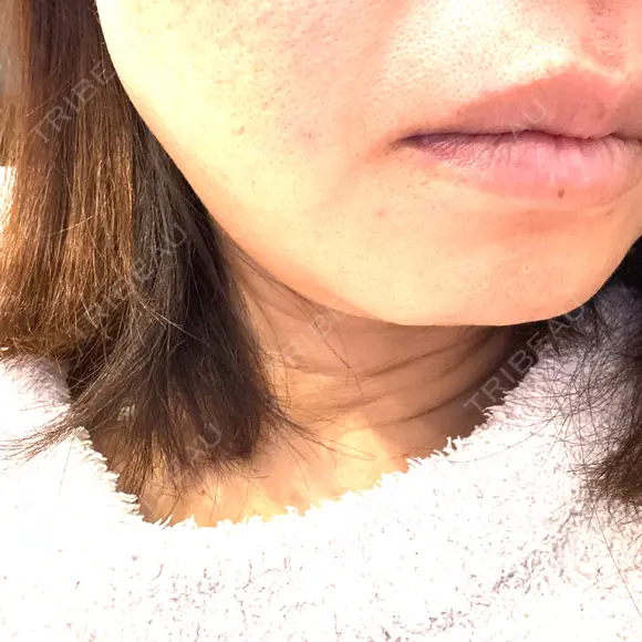 その他（輪郭） ルラ美容クリニック 大宮院 / ルラスキンクリニック 大宮院 DAY 1 メイン用