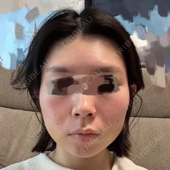 糸リフト / 脂肪吸引（顔） / ジョールファット除去 A CLINIC（エークリニック） 横浜院 DAY 5 メイン用