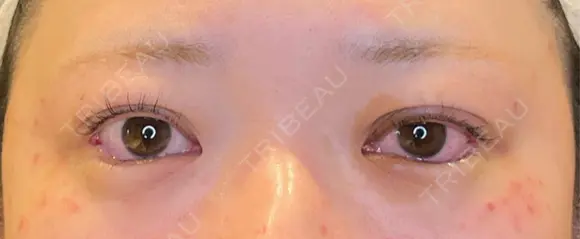 目尻切開 / タレ目形成・グラマラスライン（埋没） / ピコスポット LOUIS CLINIC 二子玉川院【ルイクリニック】 DAY 0 メイン用