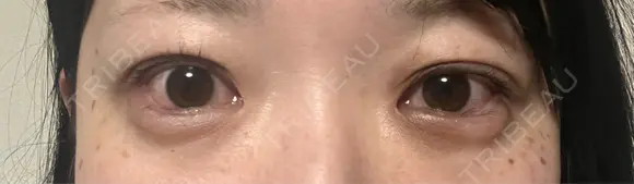 目尻切開 / タレ目形成・グラマラスライン（埋没） / ピコスポット LOUIS CLINIC 二子玉川院【ルイクリニック】 DAY 2 メイン用