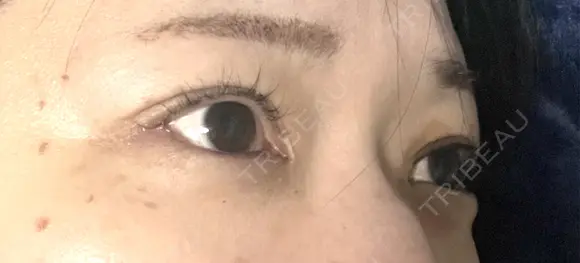 目尻切開 / タレ目形成・グラマラスライン（埋没） / ピコスポット LOUIS CLINIC 二子玉川院【ルイクリニック】 DAY 3 メイン用