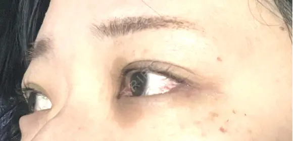 目尻切開 / タレ目形成・グラマラスライン（埋没） / ピコスポット LOUIS CLINIC 二子玉川院【ルイクリニック】 DAY 3 メイン用