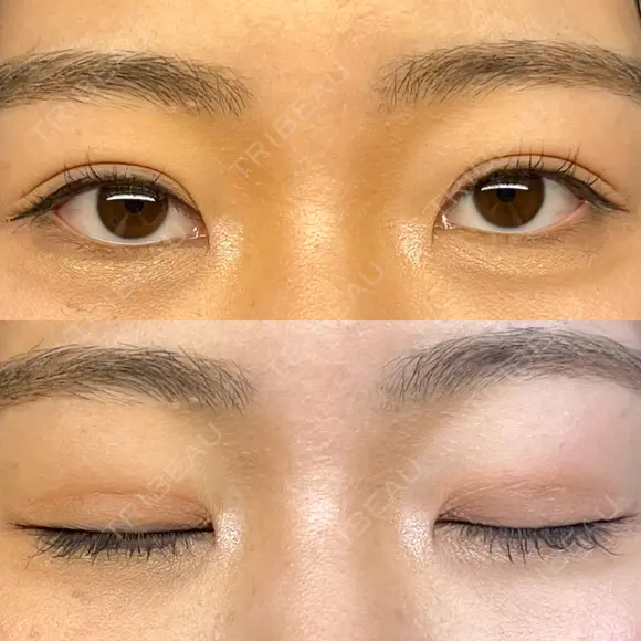 二重埋没 WOM CLINIC GINZA （ワム クリニック ギンザ） DAY 27 メイン用