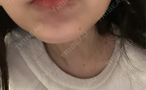 ボトックス（あご） / ボトックス（エラ・小顔） / ボトックス（眉間） TCB東京中央美容外科 枚方院 AFTER メイン用