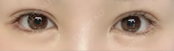 二重切開 / 眼瞼下垂（切開） ユア美容クリニック 福岡院 DAY 48 メイン用