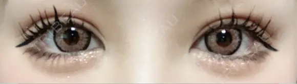 二重切開 / 眼瞼下垂（切開） ユア美容クリニック 福岡院 DAY 52 メイン用