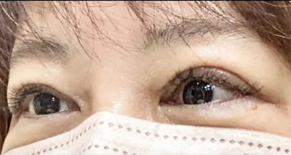 眼瞼下垂（切開） 博多もへじのクリニック AFTER メイン用