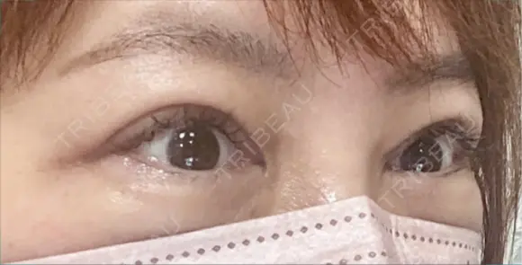 眼瞼下垂（切開） 博多もへじのクリニック DAY 54 メイン用