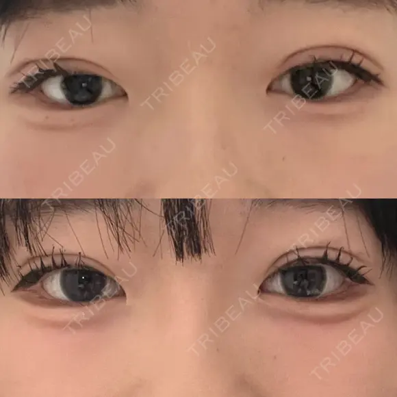 二重埋没 大塚美容形成外科 札幌院 AFTER メイン用