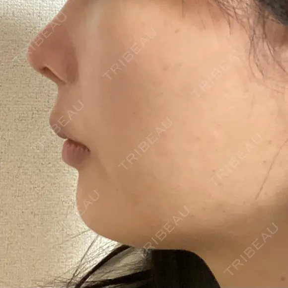 ボトックス（エラ・小顔） / ヒアルロン酸注入（唇） ルラ美容クリニック 名古屋栄院 / ルラスキンクリニック 名古屋栄院 DAY 31 メイン用