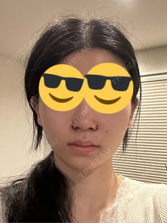 小鼻縮小（切開） くさのたろうクリニック DAY 0 メイン用