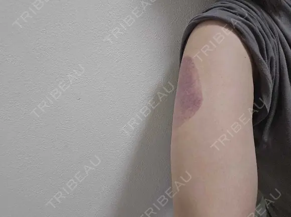 脂肪冷却（二の腕） / 脂肪冷却（お尻） DMTC CLINIC 渋谷院 DAY 0 メイン用