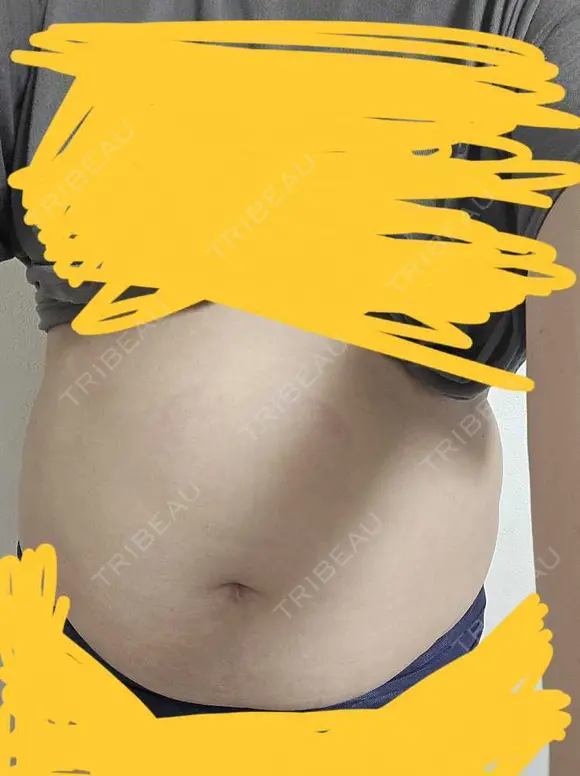 脂肪冷却（二の腕） / 脂肪冷却（お尻） DMTC CLINIC 渋谷院 DAY 0 メイン用