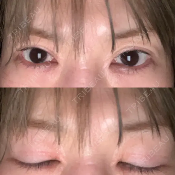 二重切開 / 目頭切開 / 上まぶたたるみ取り 湘南美容クリニック 大阪京橋院 DAY 506 メイン用