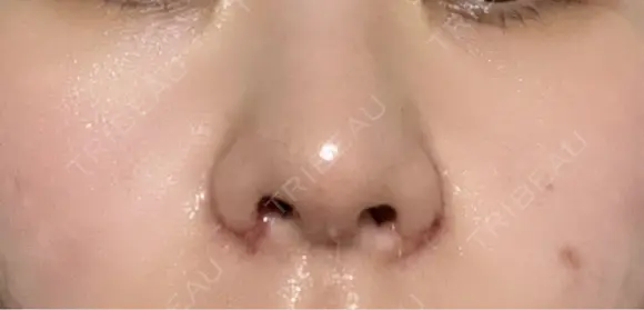 鼻尖形成（切開） / 小鼻縮小（切開） / 軟骨移植 / 鼻柱下降・鼻唇角形成（猫手術） / その他（鼻） 東京シンデレラ美容外科 池袋院 DAY 2 メイン用