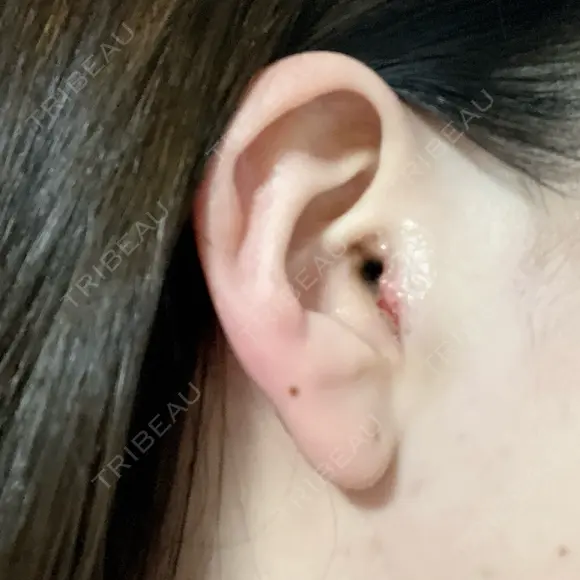 鼻尖形成（切開） / 小鼻縮小（切開） / 軟骨移植 / 鼻柱下降・鼻唇角形成（猫手術） / その他（鼻） 東京シンデレラ美容外科 池袋院 DAY 2 メイン用