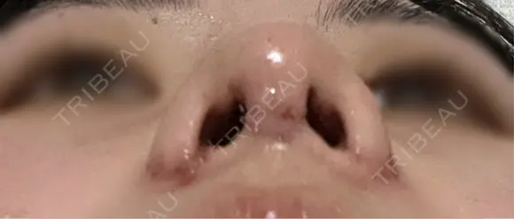 鼻尖形成（切開） / 小鼻縮小（切開） / 軟骨移植 / 鼻柱下降・鼻唇角形成（猫手術） / その他（鼻） 東京シンデレラ美容外科 池袋院 DAY 2 メイン用