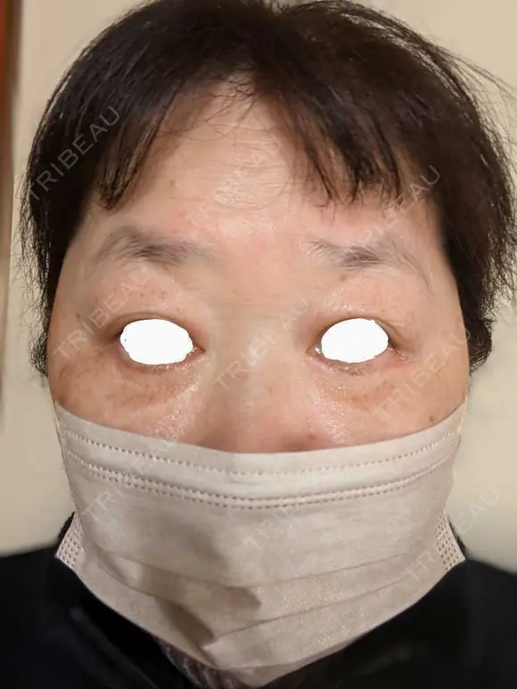 下まぶたたるみ取り / 下まぶたの脂肪取り / 脂肪注入（目の下） アリエル美容クリニック 郡山院 DAY 62 メイン用